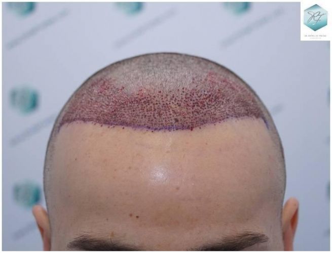 TRASPLANTE CAPILAR implante de pelo