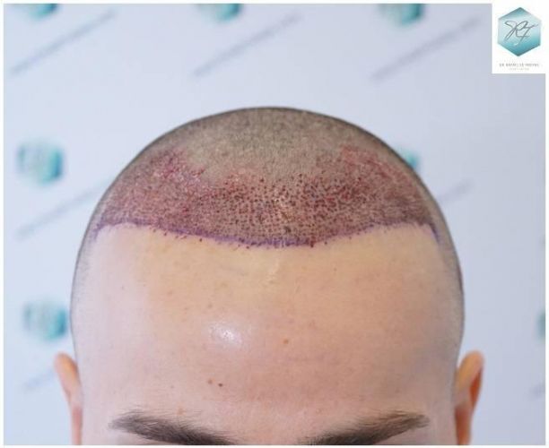 Injerto Capilar Técnica FUE Grafts 2423 (6189 Pelos) 7 implante de pelo