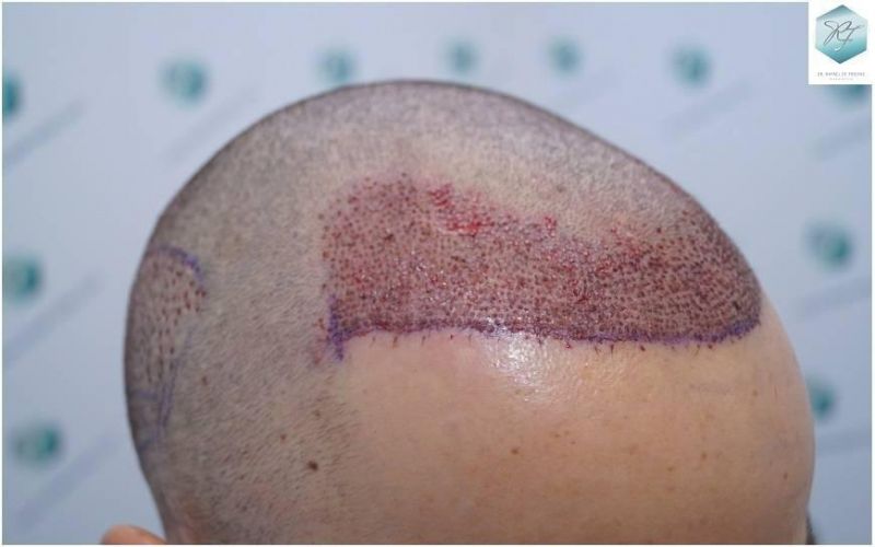 Injerto Capilar Técnica FUE Grafts 2423 (6189 Pelos) 8 implante de pelo