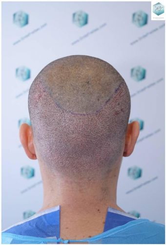 Injerto Capilar Técnica FUE Grafts 2423 (6189 Pelos) 11 implante de pelo