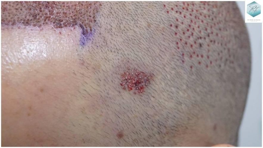 Injerto Capilar Técnica FUE Grafts 2423 (6189 Pelos) 10 injerto capilar resultados