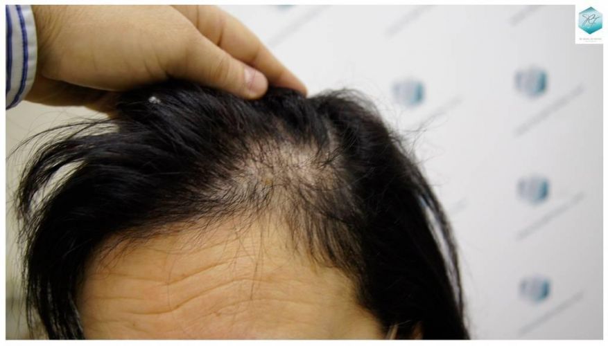 Injerto capilar Técnica FUE - Mujer 1142 Grafts (2953 Pelos) 8 Caída de pelo en mujeres
