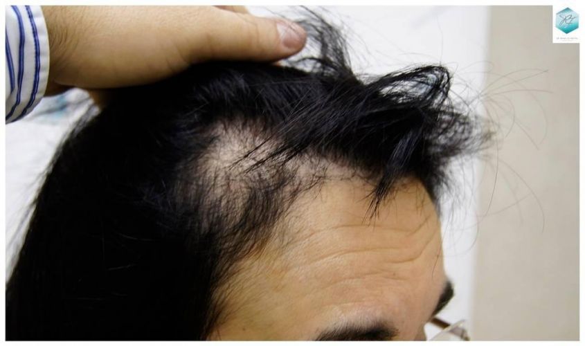 Injerto capilar Técnica FUE - Mujer 1142 Grafts (2953 Pelos) 6 Caída de pelo en mujeres