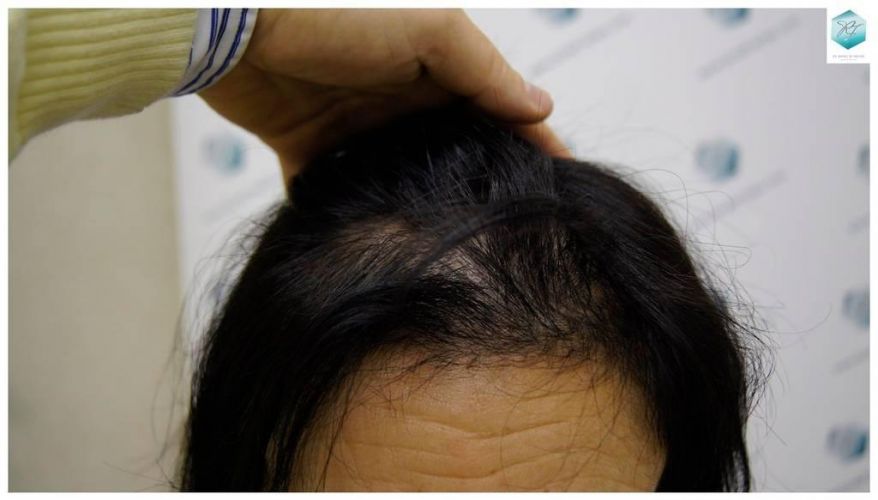 Injerto capilar Técnica FUE - Mujer 1142 Grafts (2953 Pelos) 5 Alopecia androgenética mujer