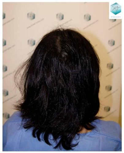 Injerto capilar Técnica FUE - Mujer 1142 Grafts (2953 Pelos) 45 Alopecia androgenética mujer