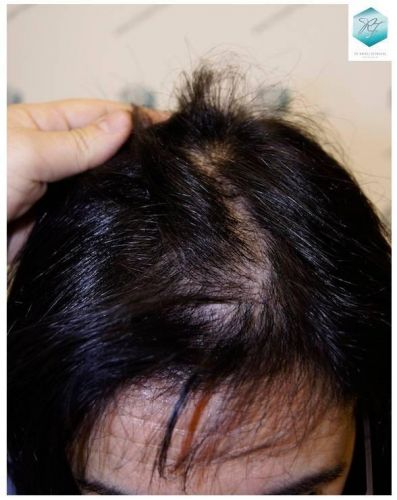 Injerto capilar Técnica FUE - Mujer 1142 Grafts (2953 Pelos) 4 Alopecia androgenética mujer