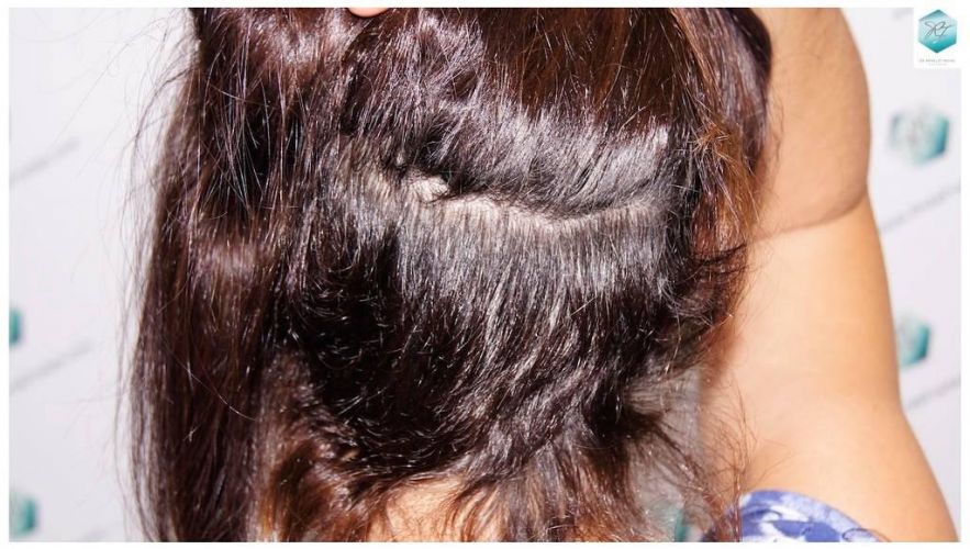Injerto capilar Técnica FUE - Mujer 1142 Grafts (2953 Pelos) 44 trasplante pelo mujer