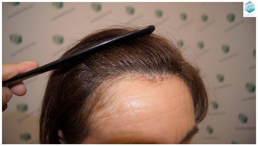 Injerto capilar Técnica FUE - Mujer 1142 Grafts (2953 Pelos) 32 trasplante pelo mujer
