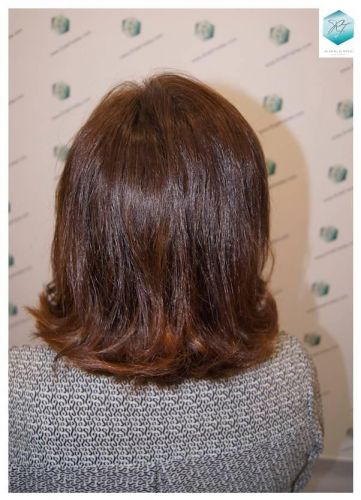 Injerto capilar Técnica FUE - Mujer 1142 Grafts (2953 Pelos) 37 recuperar pelo mujer