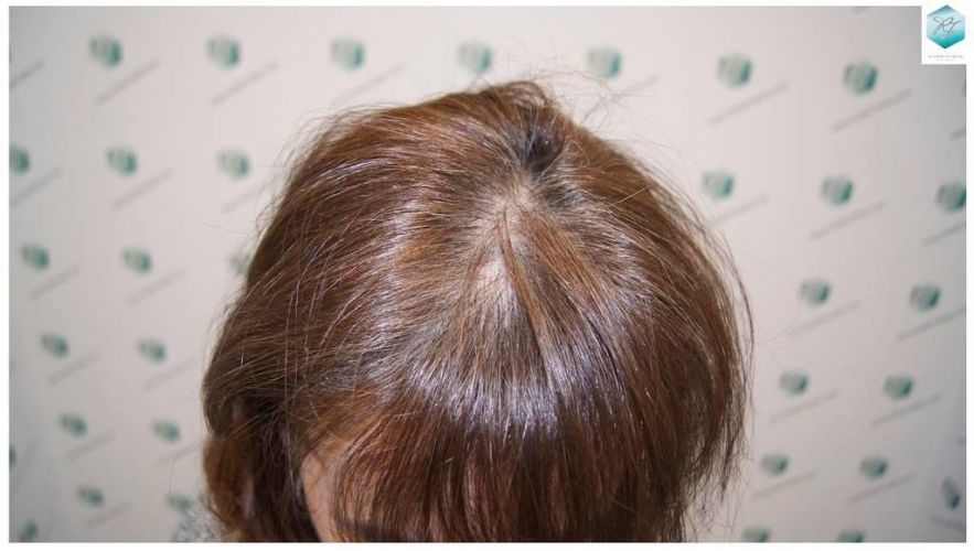 Injerto capilar Técnica FUE - Mujer 1142 Grafts (2953 Pelos) 35 trasplante de pelo mujer
