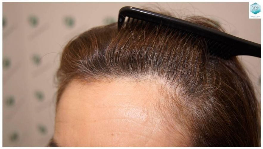 Injerto capilar Técnica FUE - Mujer 1142 Grafts (2953 Pelos) 34 trasplante de pelo mujer