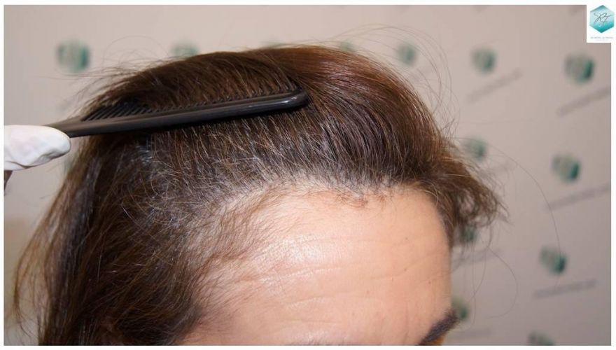 Injerto capilar Técnica FUE - Mujer 1142 Grafts (2953 Pelos) 31 trasplante de pelo mujer
