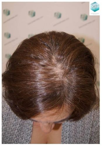 Injerto capilar Técnica FUE - Mujer 1142 Grafts (2953 Pelos) 29 trasplante de pelo mujer