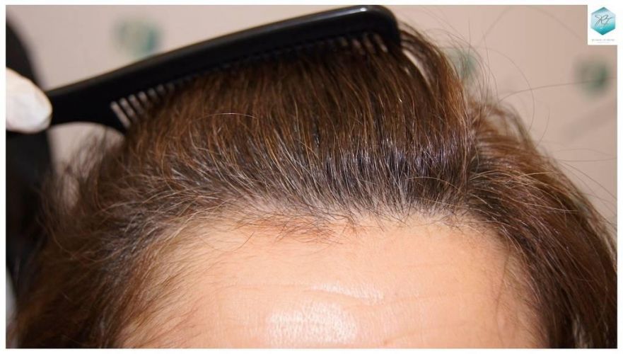 Injerto capilar Técnica FUE - Mujer 1142 Grafts (2953 Pelos) 41 trasplante pelo mujer