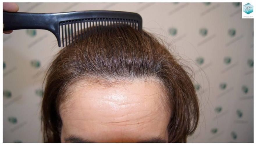 Injerto capilar Técnica FUE - Mujer 1142 Grafts (2953 Pelos) 27 trasplante cabello mujer