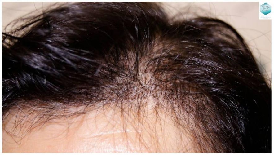 Injerto capilar Técnica FUE - Mujer 1142 Grafts (2953 Pelos) 9 trasplante cabello mujer