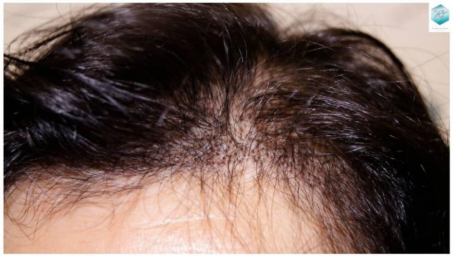 trasplante cabello mujer