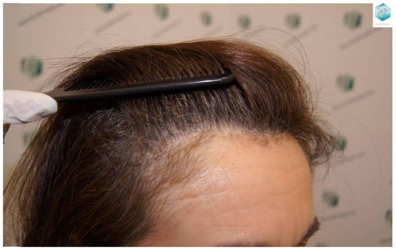 Injerto capilar Técnica FUE - Mujer 1142 Grafts (2953 Pelos) 30 trasplante cabello mujer