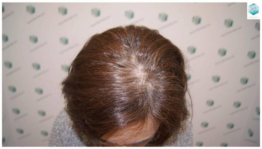 Injerto capilar Técnica FUE - Mujer 1142 Grafts (2953 Pelos) 28 trasplante cabello mujer