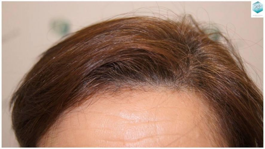 Injerto capilar Técnica FUE - Mujer 1142 Grafts (2953 Pelos) 26 trasplante cabello mujer
