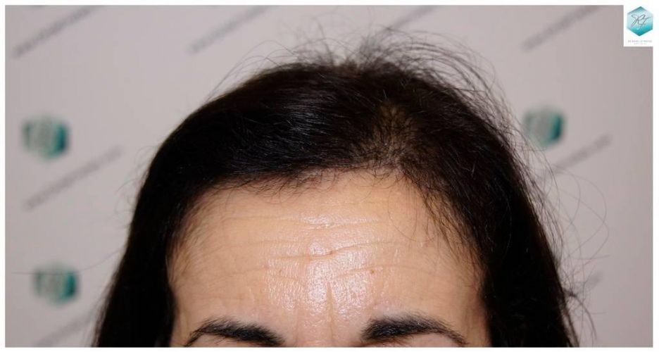 Injerto capilar Técnica FUE - Mujer 1142 Grafts (2953 Pelos) 1 trasplante cabello mujer