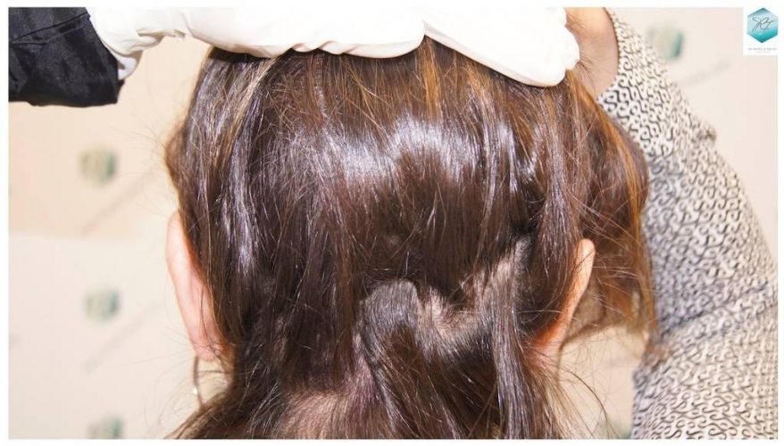 Injerto capilar Técnica FUE - Mujer 1142 Grafts (2953 Pelos) 43 pelo mujer
