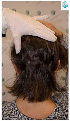 Injerto capilar Técnica FUE - Mujer 1142 Grafts (2953 Pelos) 42 pelo mujer