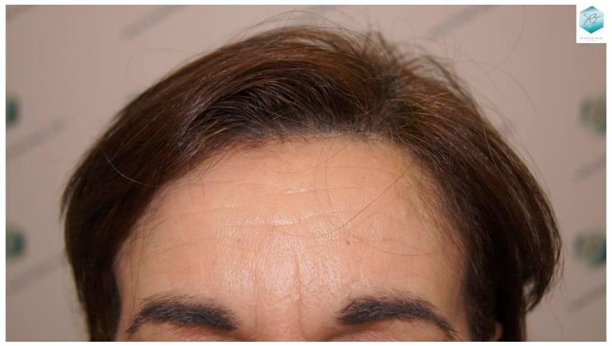 Injerto capilar Técnica FUE - Mujer 1142 Grafts (2953 Pelos) 40 trasplante pelo mujer
