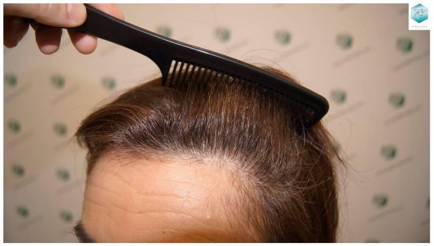 Injerto capilar Técnica FUE - Mujer 1142 Grafts (2953 Pelos) 39 trasplante pelo mujer