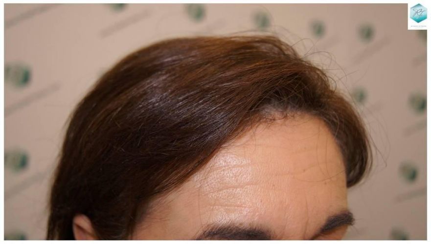 Injerto capilar Técnica FUE - Mujer 1142 Grafts (2953 Pelos) 33 trasplante pelo mujer