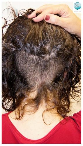 Injerto capilar Técnica FUE - Mujer 1142 Grafts (2953 Pelos) 38 trasplante pelo mujer