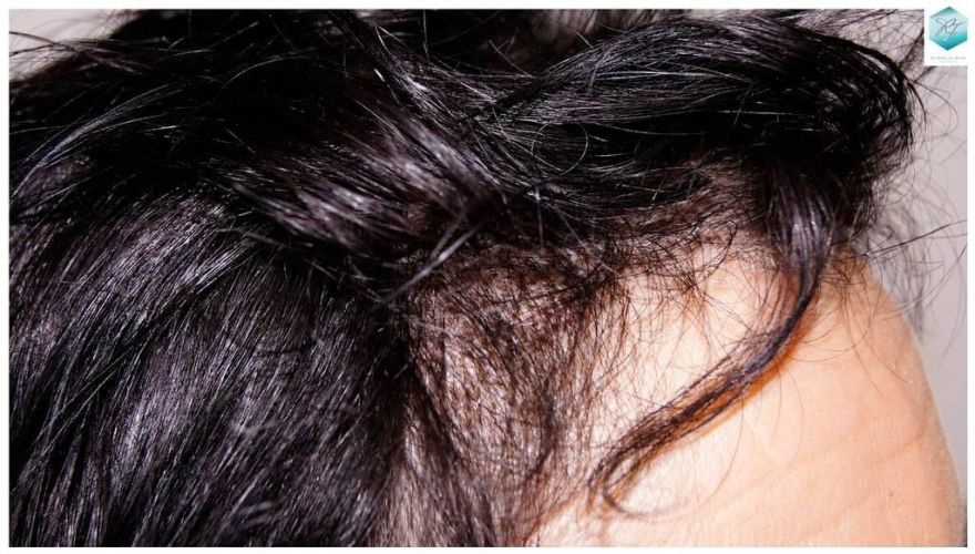 Injerto capilar Técnica FUE - Mujer 1142 Grafts (2953 Pelos) 7 trasplante pelo mujer