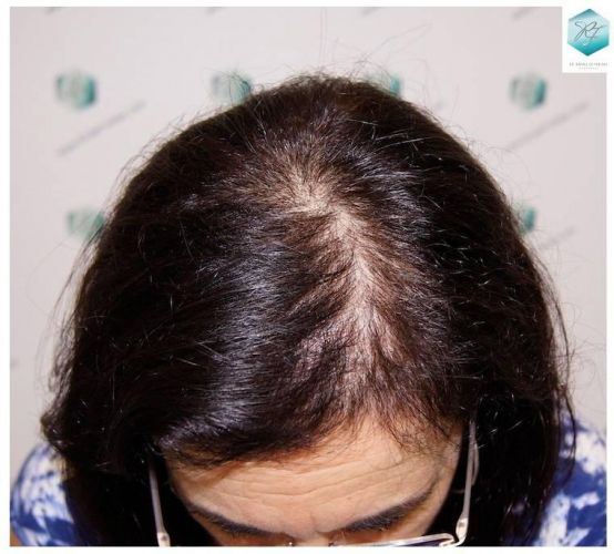 Injerto capilar Técnica FUE - Mujer 1142 Grafts (2953 Pelos) 13 trasplante pelo mujer