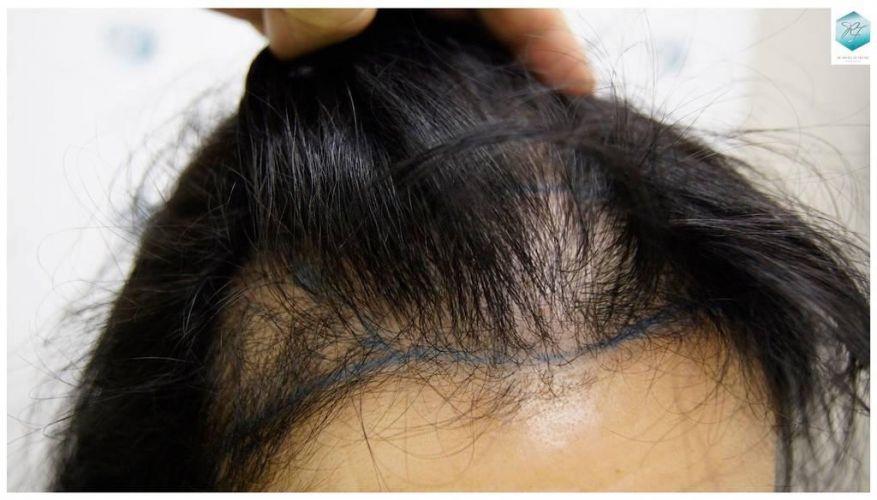 Injerto capilar Técnica FUE - Mujer 1142 Grafts (2953 Pelos) 18 Alopecia androgenética mujer