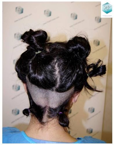 Injerto capilar Técnica FUE - Mujer 1142 Grafts (2953 Pelos) 21 Alopecia androgenética mujer