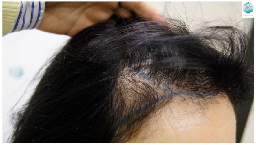Injerto capilar Técnica FUE - Mujer 1142 Grafts (2953 Pelos) 17 Alopecia androgenética mujer