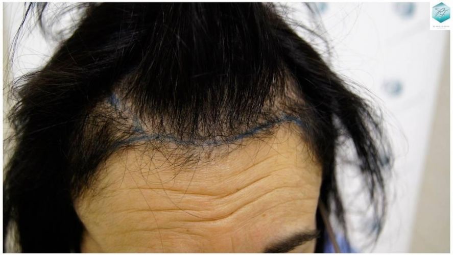 Injerto capilar Técnica FUE - Mujer 1142 Grafts (2953 Pelos) 16 Alopecia androgenética mujer
