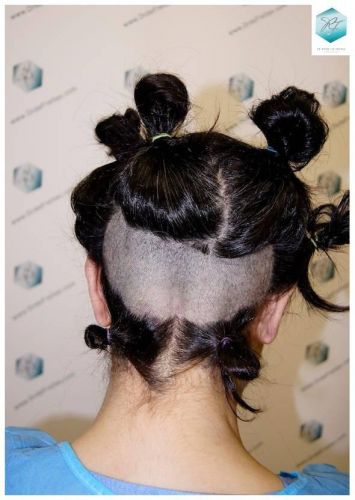 Injerto capilar Técnica FUE - Mujer 1142 Grafts (2953 Pelos) 20 Alopecia androgenética mujer