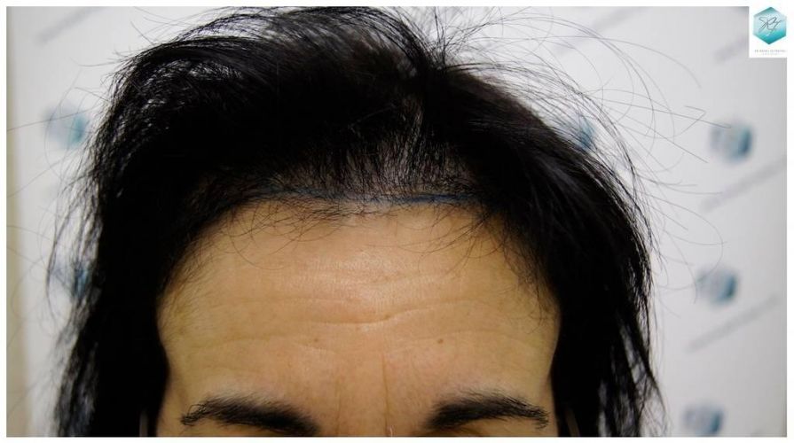 DISEÑO LÍNEA INJERTO Alopecia androgenética mujer