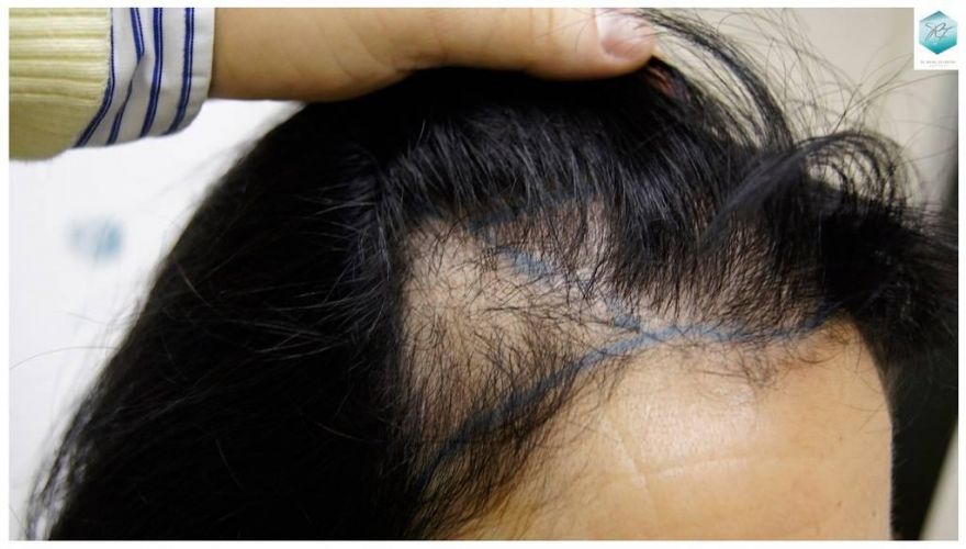 Injerto capilar Técnica FUE - Mujer 1142 Grafts (2953 Pelos) 14 Alopecia androgenética mujer