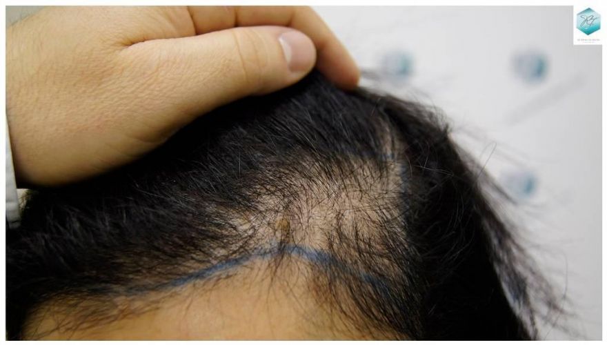 Injerto capilar Técnica FUE - Mujer 1142 Grafts (2953 Pelos) 15 Alopecia androgenética mujer