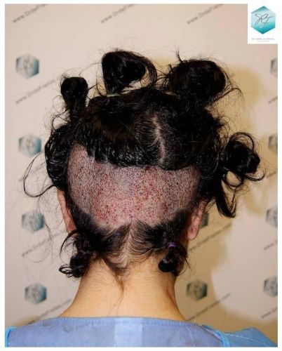 Injerto capilar Técnica FUE - Mujer 1142 Grafts (2953 Pelos) 25 trasplante pelo mujer