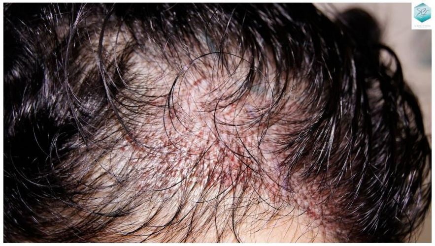 Injerto capilar Técnica FUE - Mujer 1142 Grafts (2953 Pelos) 23 trasplante pelo mujer