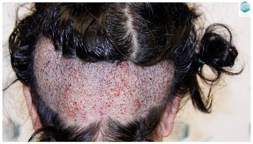 Injerto capilar Técnica FUE - Mujer 1142 Grafts (2953 Pelos) 24 trasplante pelo mujer