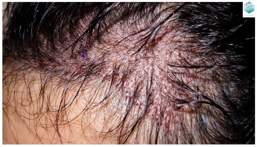 Injerto capilar Técnica FUE - Mujer 1142 Grafts (2953 Pelos) 22 trasplante pelo mujer