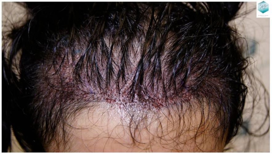 TRASPLANTE CAPILAR trasplante pelo mujer
