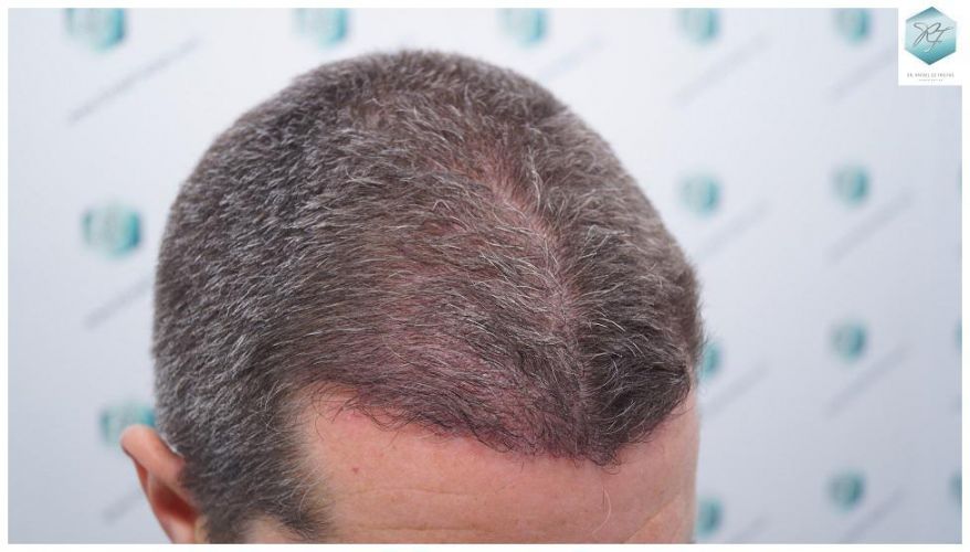 Injerto Capilar Técnica FUE 2911 Grafts (Pelos 6191) 20 mejor clinica españa injerto capilar