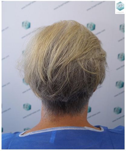 Injerto Capilar Técnica FUE 2803 Grafts (6691 pelos) 39 mejor clinica españa injerto capilar