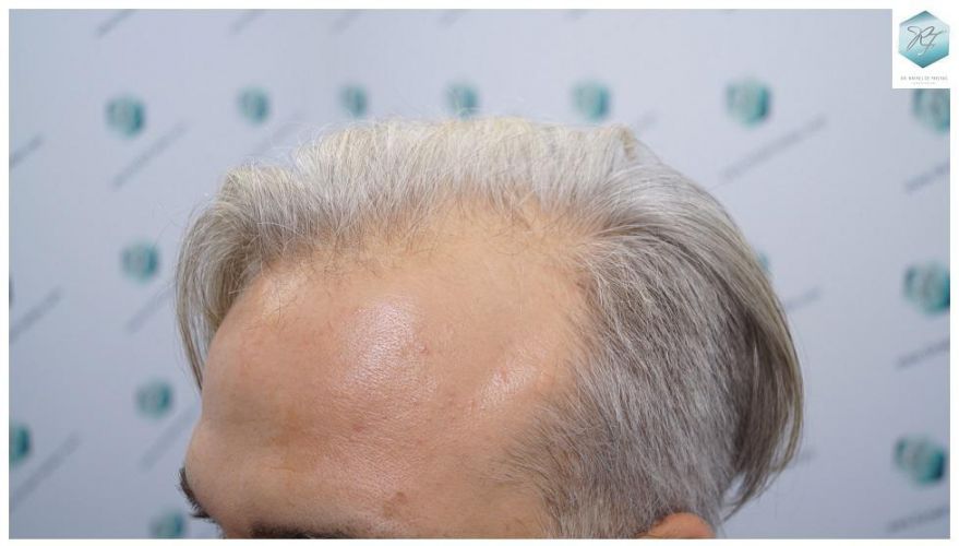 Injerto Capilar Técnica FUE 2803 Grafts (6691 pelos) 4 injerto capilar valencia