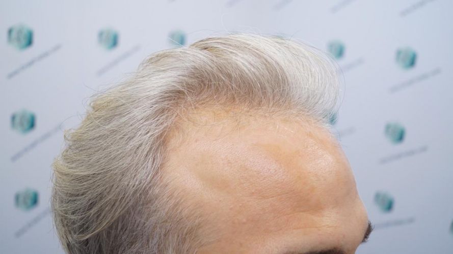 Injerto Capilar Técnica FUE 2803 Grafts (6691 pelos) 3 injerto capilar valencia
